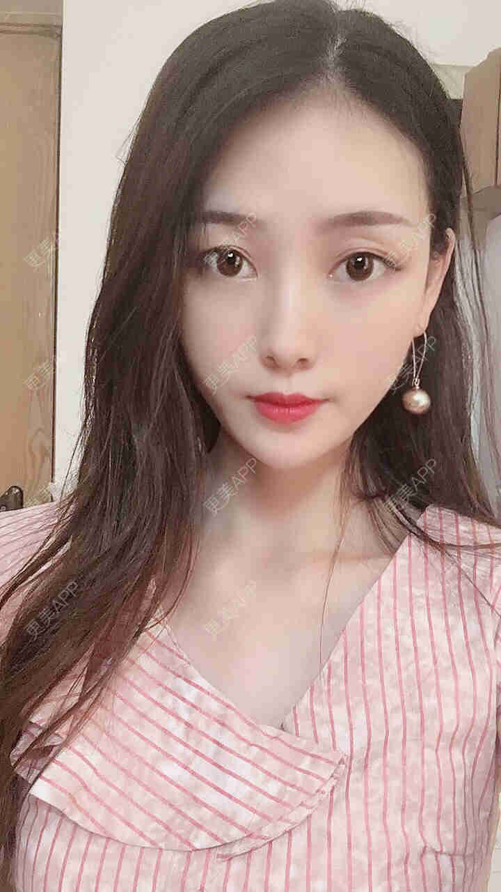 更美 - 芝麻芝麻开开门的自体脂肪全面部填充经验 | 自体脂肪全面部填充 | 视频日记 | 重庆