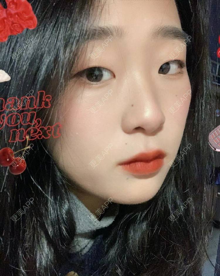 更美 - 更美用户lbSQhckZnF的激光溶脂瘦脸经验 | 激光溶脂瘦脸
