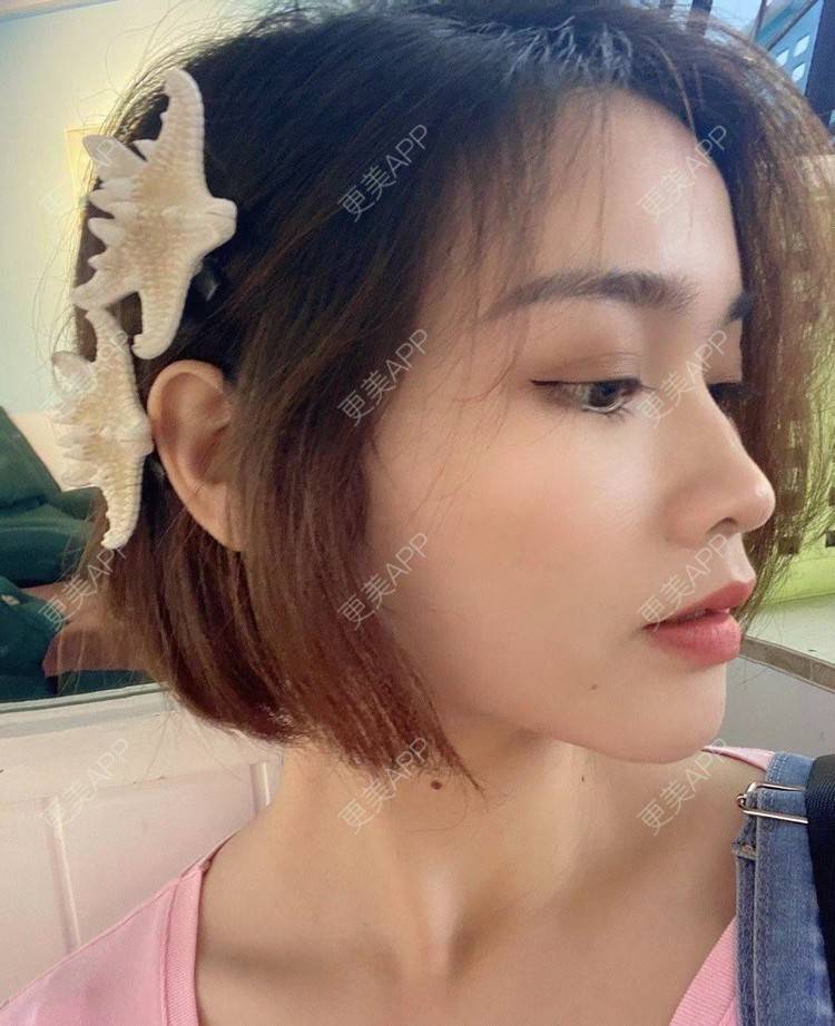 更美 - 更美用户dnUsA7LA0u的激光溶脂瘦脸经验 | 激光溶脂瘦脸