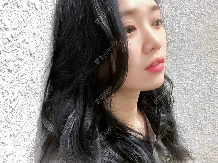 更美 - 等风啊熊抱啊的埋线提升经验 | 北京 | 埋线提升