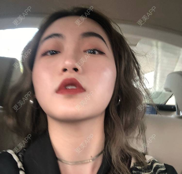 更美 - 誠意ナ到吃卟消ξ细的注射溶脂瘦脸经验 | 北京 | 注射溶脂瘦脸