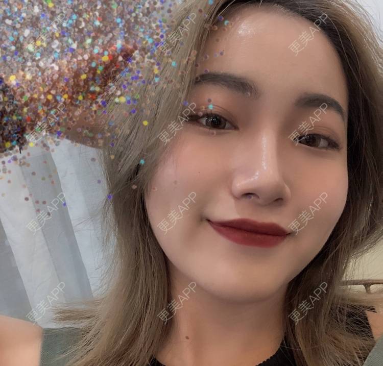 更美 - 誠意ナ到吃卟消ξ细的注射溶脂瘦脸经验 | 北京 | 注射溶脂瘦脸
