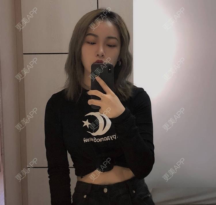 更美 - 誠意ナ到吃卟消ξ细的注射溶脂瘦脸经验 | 北京 | 注射溶脂瘦脸