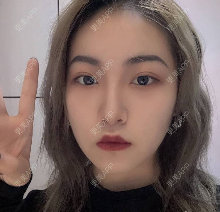 更美 - 誠意ナ到吃卟消ξ细的注射溶脂瘦脸经验 | 北京 | 注射溶脂瘦脸