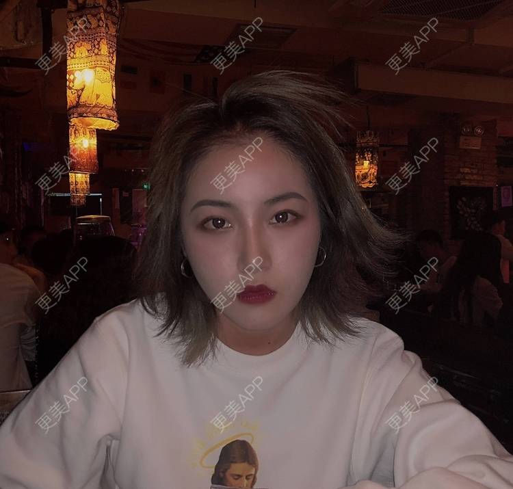 更美 - 誠意ナ到吃卟消ξ细的注射溶脂瘦脸经验 | 北京 | 注射溶脂瘦脸