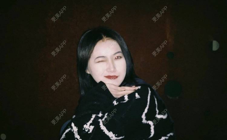 更美 - 誠意ナ到吃卟消ξ细的注射溶脂瘦脸经验 | 北京 | 注射溶脂瘦脸