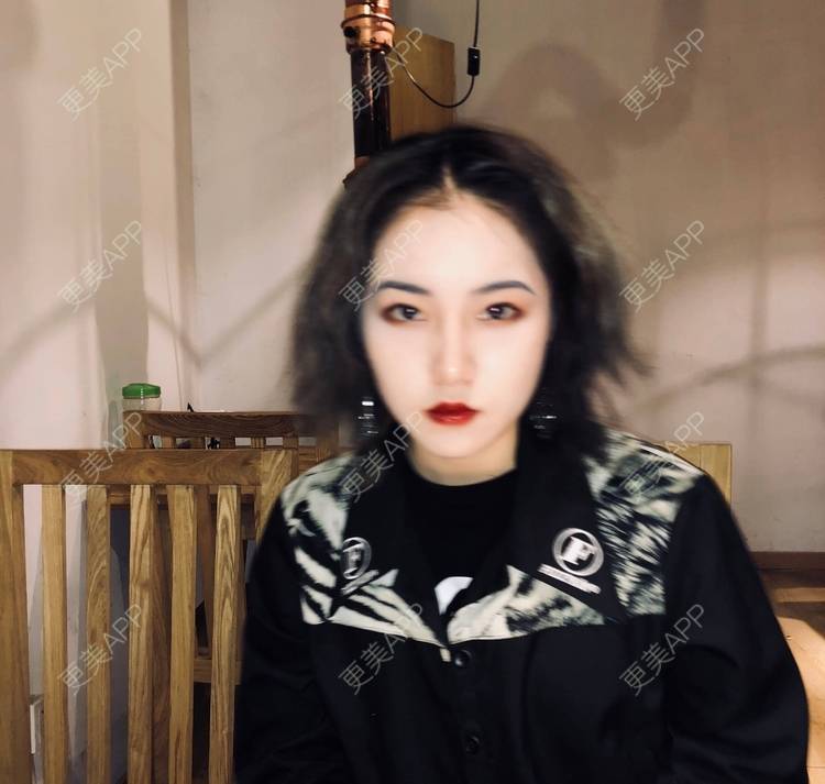 更美 - 誠意ナ到吃卟消ξ细的注射溶脂瘦脸经验 | 北京 | 注射溶脂瘦脸