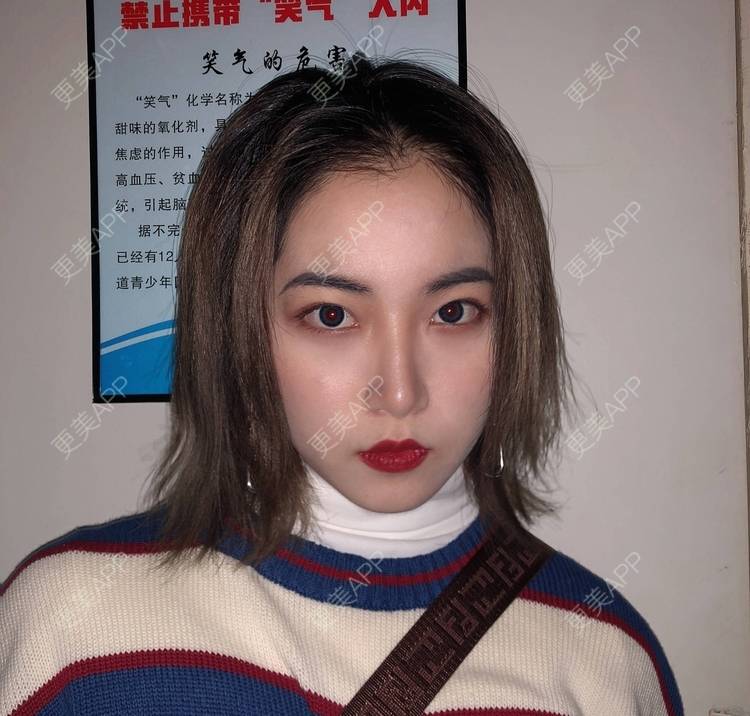 更美 - 誠意ナ到吃卟消ξ细的注射溶脂瘦脸经验 | 北京 | 注射溶脂瘦脸