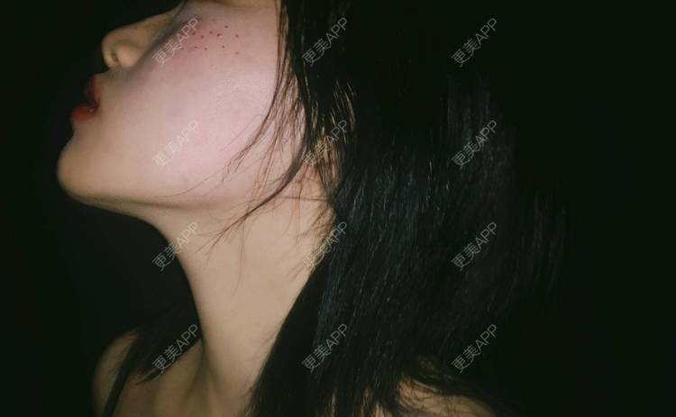 更美 - 誠意ナ到吃卟消ξ细的注射溶脂瘦脸经验 | 北京 | 注射溶脂瘦脸