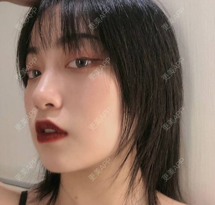更美 - 誠意ナ到吃卟消ξ细的注射溶脂瘦脸经验 | 北京 | 注射溶脂瘦脸