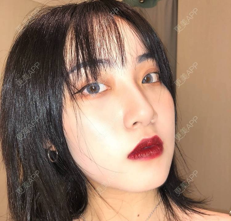 更美 - 誠意ナ到吃卟消ξ细的注射溶脂瘦脸经验 | 北京 | 注射溶脂瘦脸