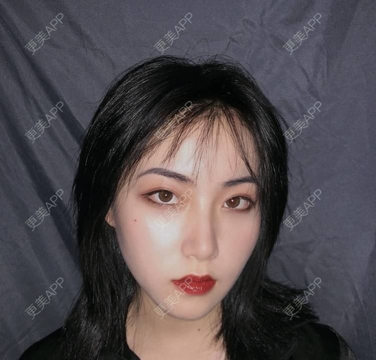更美 - 誠意ナ到吃卟消ξ细的注射溶脂瘦脸经验 | 北京 | 注射溶脂瘦脸