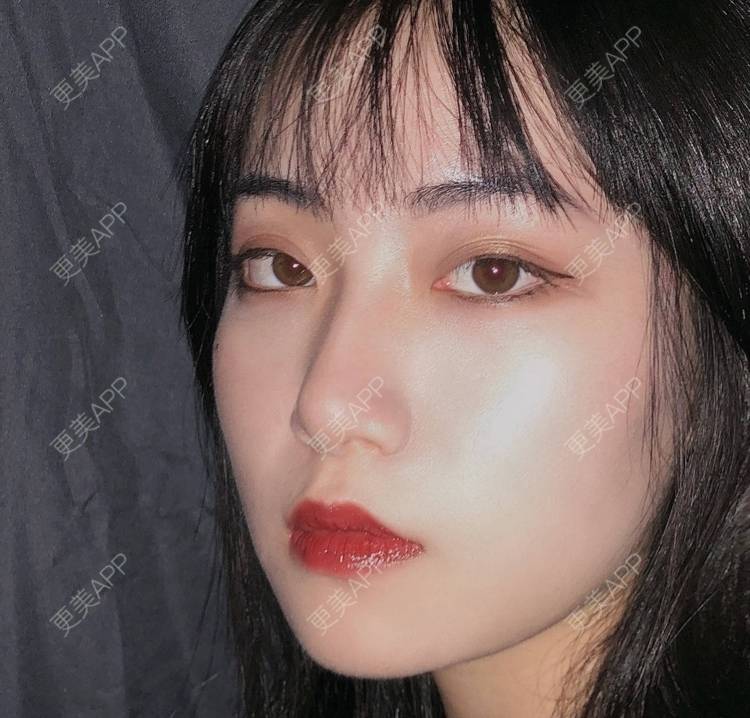 更美 - 誠意ナ到吃卟消ξ细的注射溶脂瘦脸经验 | 北京 | 注射溶脂瘦脸