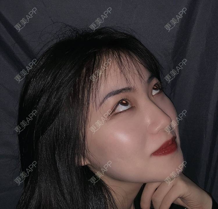 更美 - 誠意ナ到吃卟消ξ细的注射溶脂瘦脸经验 | 北京 | 注射溶脂瘦脸