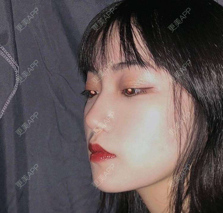 更美 - 誠意ナ到吃卟消ξ细的注射溶脂瘦脸经验 | 北京 | 注射溶脂瘦脸