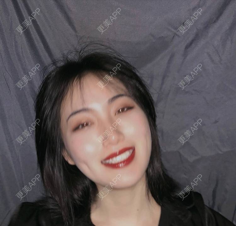更美 - 誠意ナ到吃卟消ξ细的注射溶脂瘦脸经验 | 北京 | 注射溶脂瘦脸