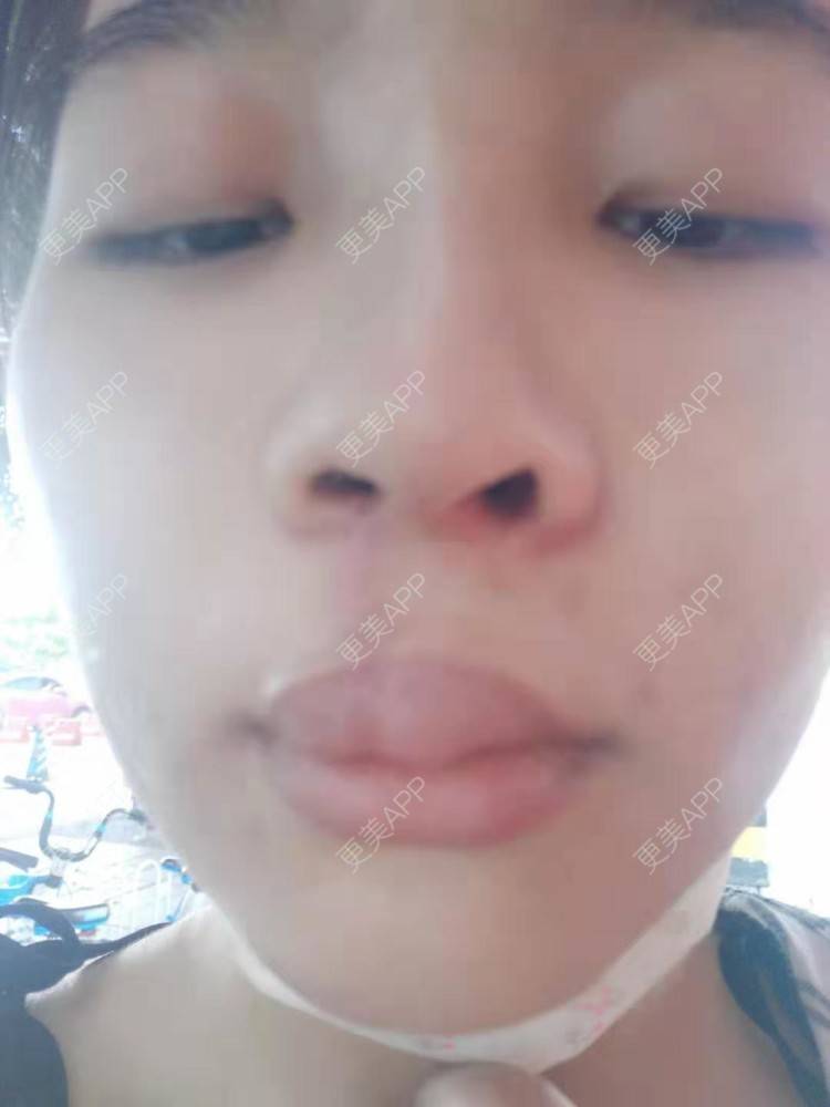 更美 - 比丢biubiu的鼻部综合经验 | 广州 | 视频日记 | 鼻部综合