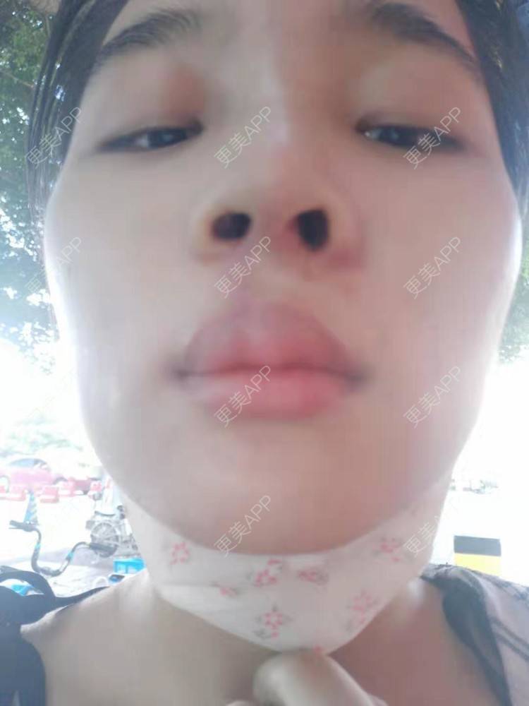 更美 - 比丢biubiu的鼻部综合经验 | 广州 | 视频日记 | 鼻部综合