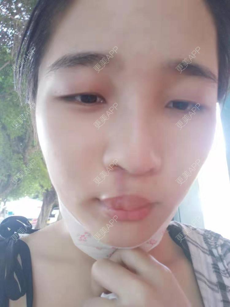 更美 - 比丢biubiu的鼻部综合经验 | 广州 | 视频日记 | 鼻部综合