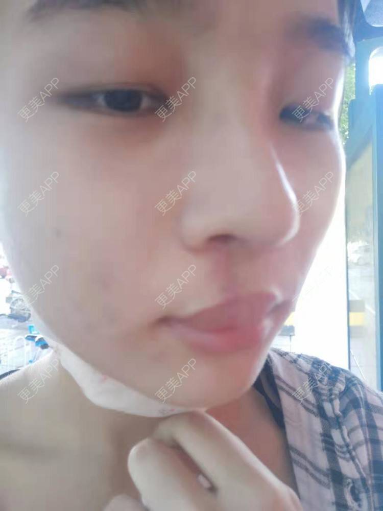 更美 - 比丢biubiu的鼻部综合经验 | 广州 | 视频日记 | 鼻部综合