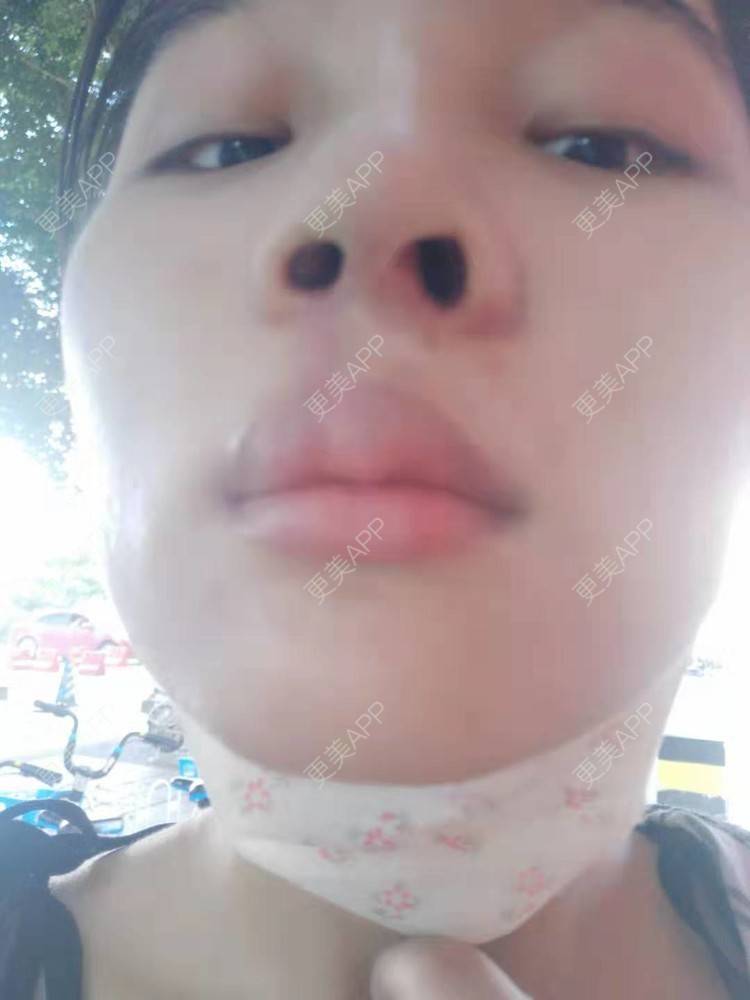 更美 - 比丢biubiu的鼻部综合经验 | 广州 | 视频日记 | 鼻部综合