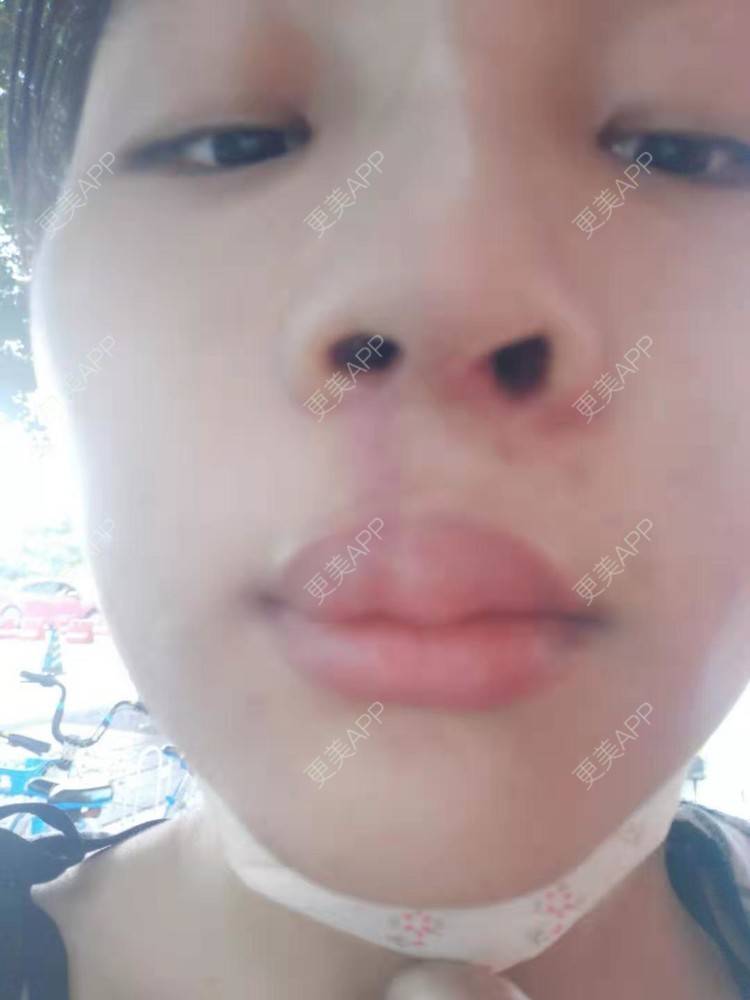 更美 - 比丢biubiu的鼻部综合经验 | 广州 | 视频日记 | 鼻部综合