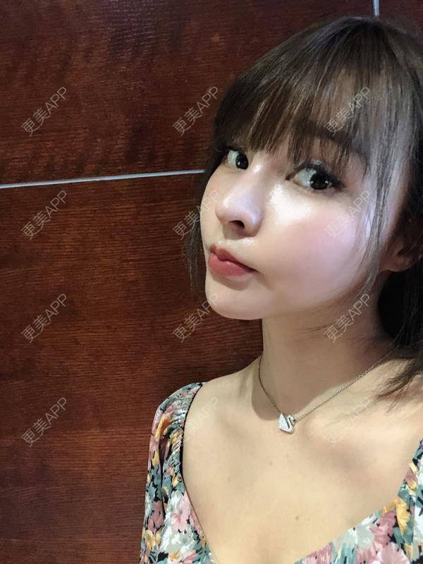 更美 - 更美用户w7xzDQyhGZ的鼻部多项经验 | 鼻部多项 | 肋软骨隆鼻 | 鼻形态修复 | 鼻部硅胶假体取出