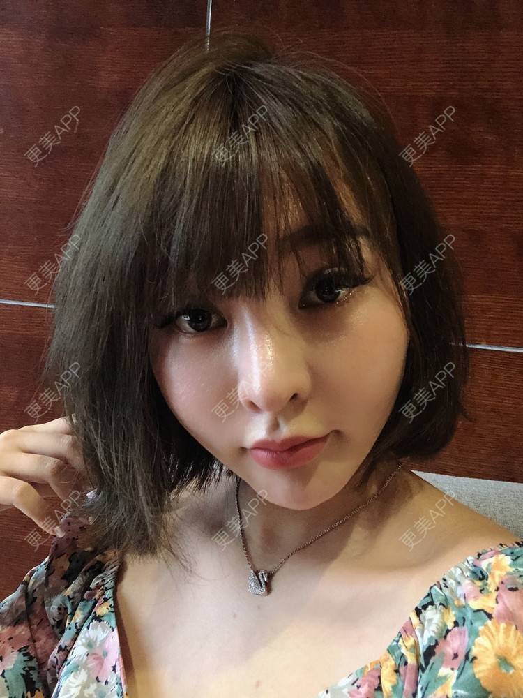 更美 - 更美用户w7xzDQyhGZ的鼻部多项经验 | 鼻部多项 | 肋软骨隆鼻 | 鼻形态修复 | 鼻部硅胶假体取出