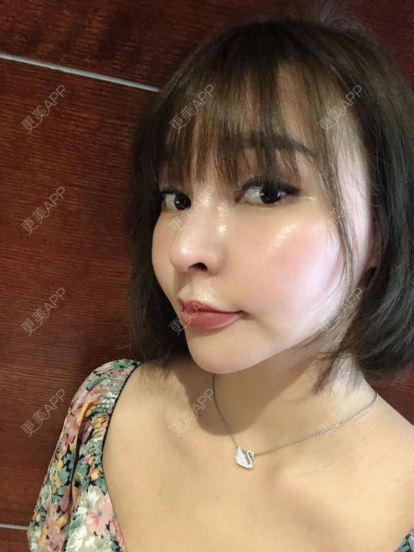 更美 - 更美用户w7xzDQyhGZ的鼻部多项经验 | 鼻部多项 | 肋软骨隆鼻 | 鼻形态修复 | 鼻部硅胶假体取出