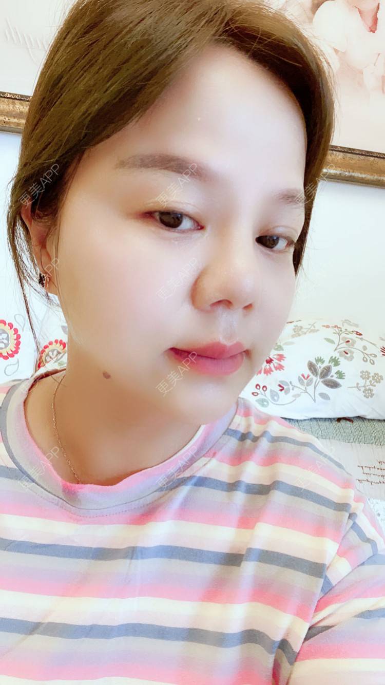 更美 - 一个人不可能的埋线除皱经验 | 视频日记 | 埋线除皱