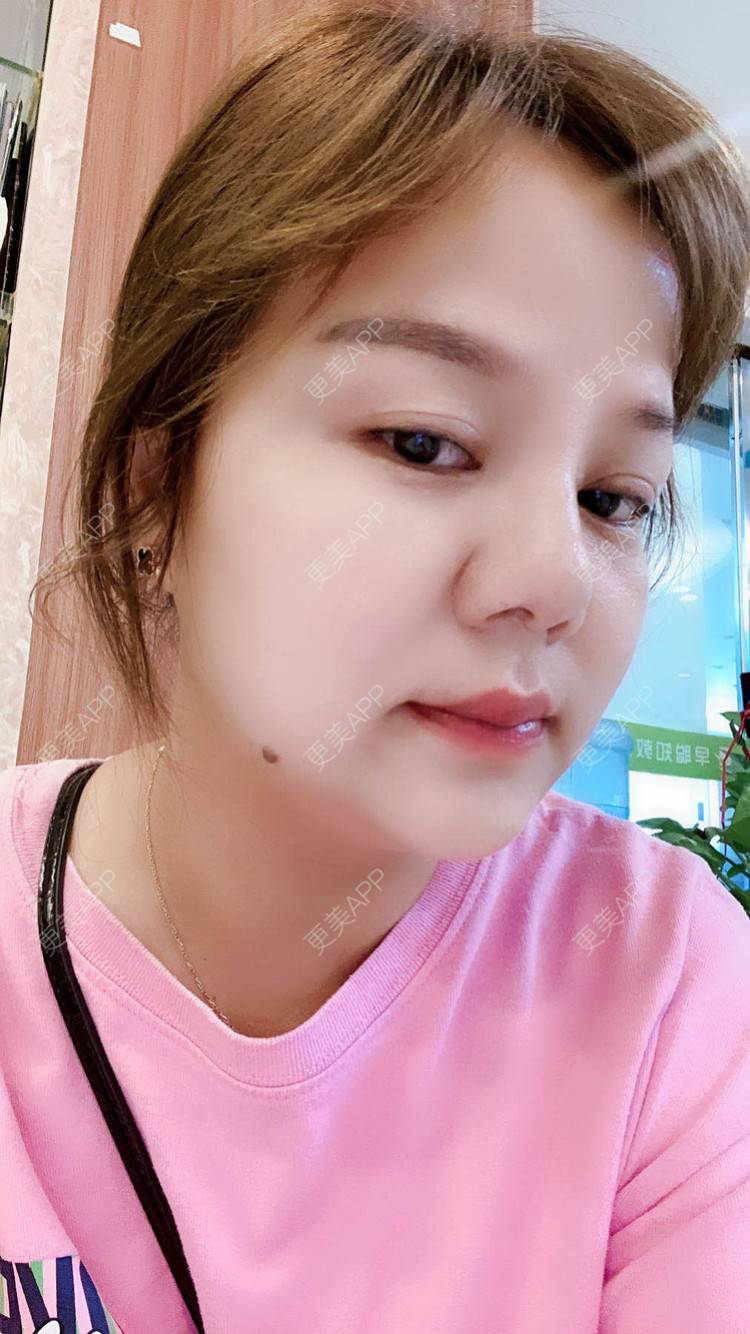 更美 - 一个人不可能的埋线除皱经验 | 视频日记 | 埋线除皱