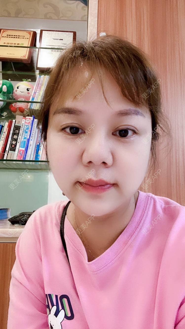 更美 - 一个人不可能的埋线除皱经验 | 视频日记 | 埋线除皱