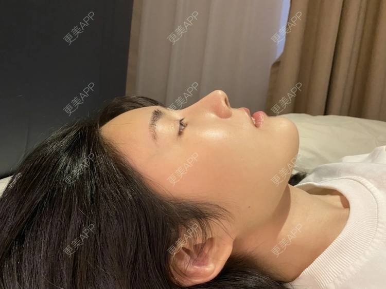 更美 - 更美用户DMn8FvdiEg的耳软骨隆鼻经验 | 武汉 | 耳软骨隆鼻