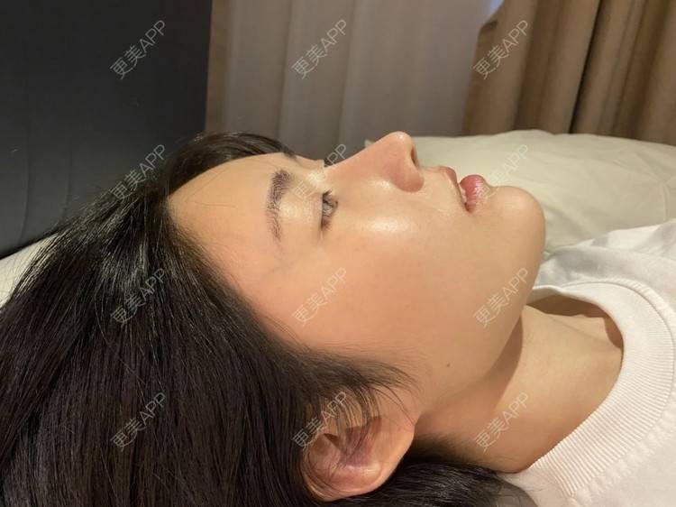 更美 - 更美用户DMn8FvdiEg的耳软骨隆鼻经验 | 武汉 | 耳软骨隆鼻