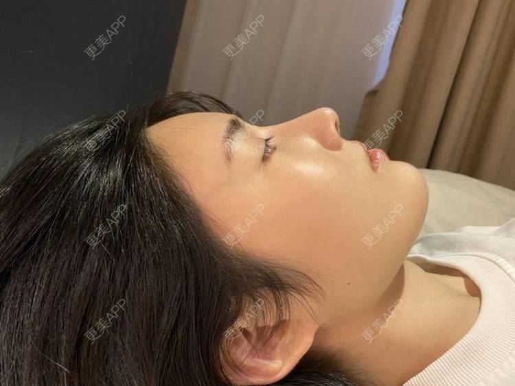 更美 - 更美用户DMn8FvdiEg的耳软骨隆鼻经验 | 武汉 | 耳软骨隆鼻