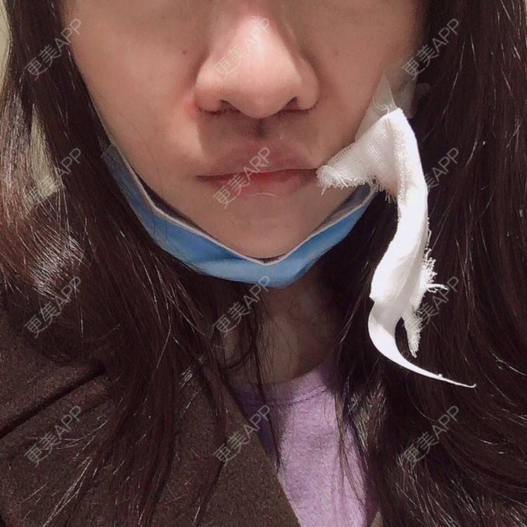 更美 - 阿狸的城堡🏰的唇腭裂修复经验 | 唇腭裂修复 | 蚌埠