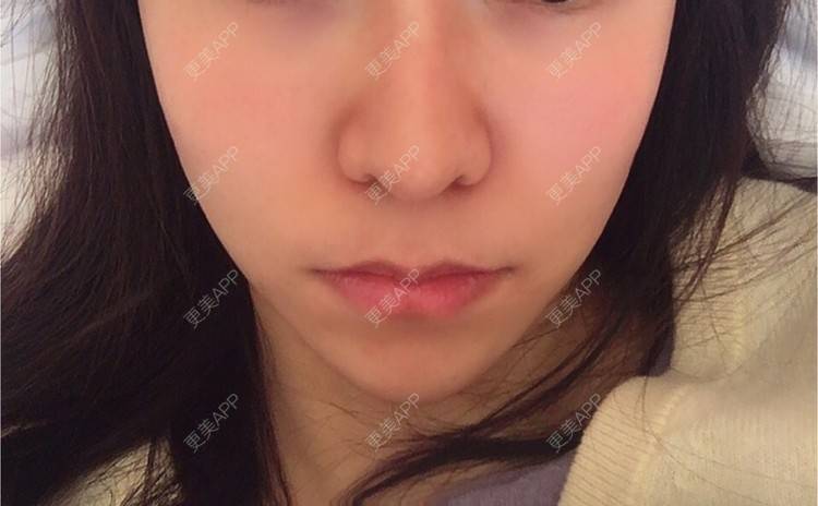 更美 - 阿狸的城堡🏰的唇腭裂修复经验 | 唇腭裂修复 | 蚌埠