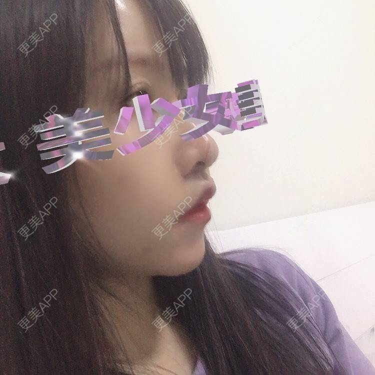 更美 - 阿狸的城堡🏰的唇腭裂修复经验 | 唇腭裂修复 | 蚌埠
