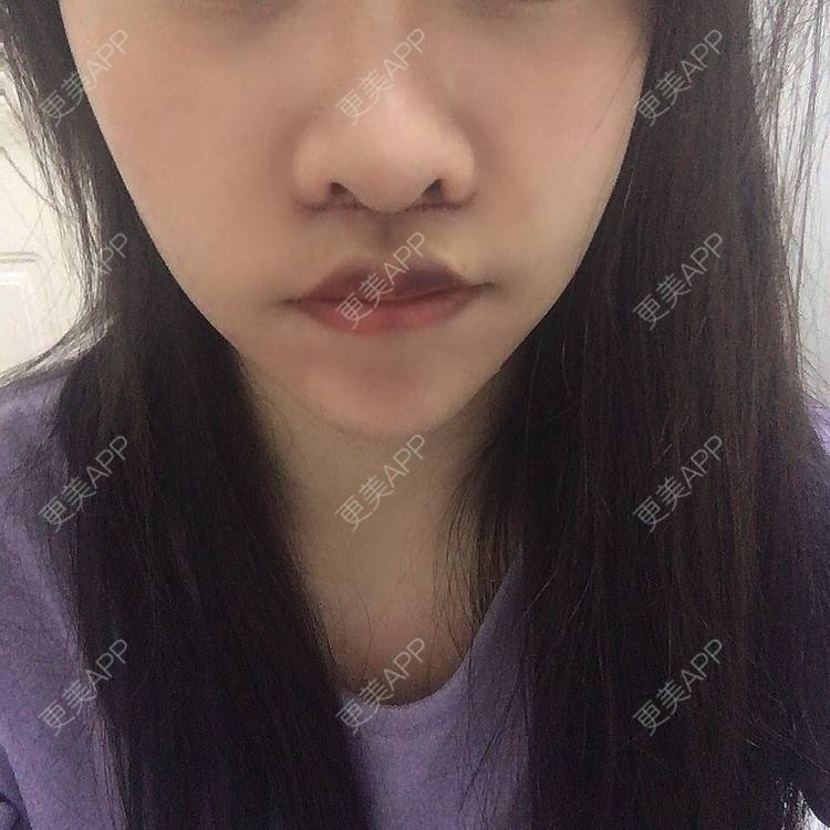 更美 - 阿狸的城堡🏰的唇腭裂修复经验 | 唇腭裂修复 | 蚌埠