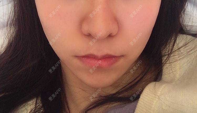 更美 - 阿狸的城堡🏰的唇腭裂修复经验 | 唇腭裂修复 | 蚌埠