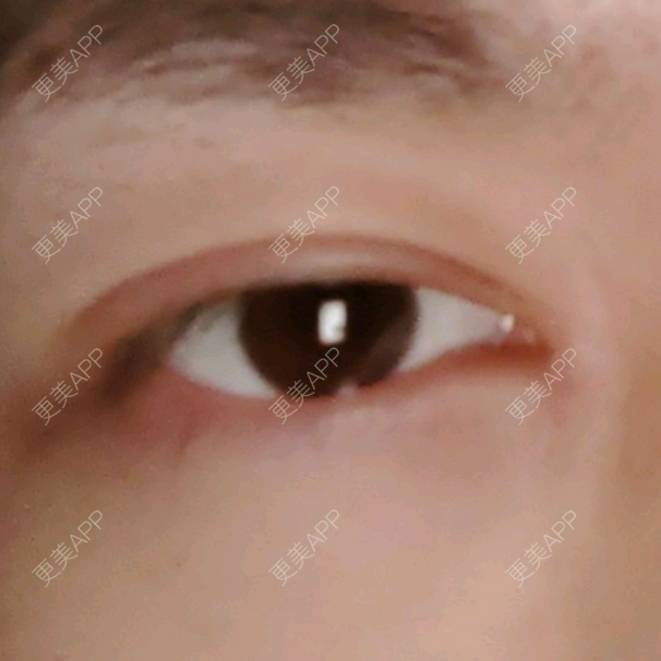 更美 - 更美用户3EvFztLgvT的全切双眼皮经验 | 全切双眼皮 | 武汉