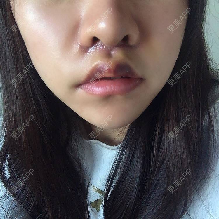 更美 - 阿狸的城堡🏰的唇腭裂修复经验 | 唇腭裂修复 | 蚌埠