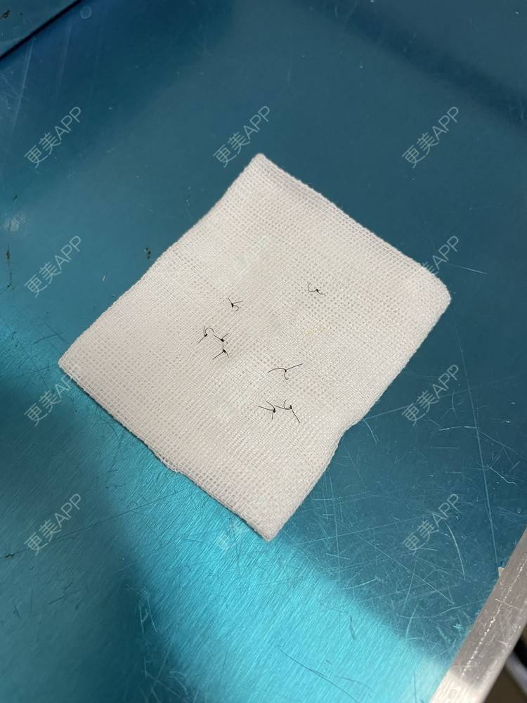 更美 - 更美用户TTx0mKb4QJ的吸脂瘦大腿经验 | 吸脂瘦大腿 | 广州