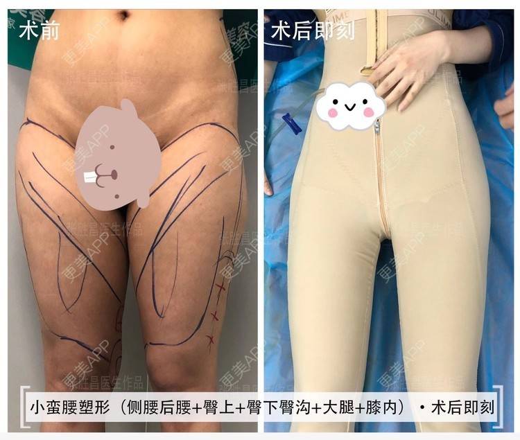 更美 - 更美用户TTx0mKb4QJ的吸脂瘦大腿经验 | 吸脂瘦大腿 | 广州