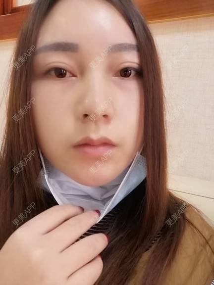 更美 - 更美用户35W00VbmuW的玻尿酸苹果肌经验 | 玻尿酸苹果肌 | 成都