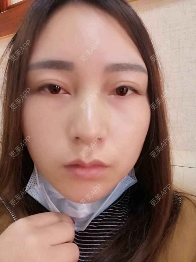 更美 - 更美用户35W00VbmuW的玻尿酸苹果肌经验 | 玻尿酸苹果肌 | 成都