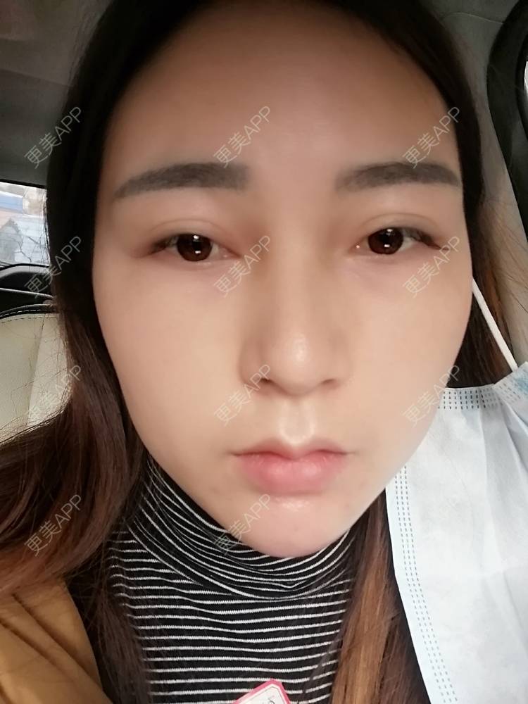 更美 - 更美用户35W00VbmuW的玻尿酸苹果肌经验 | 玻尿酸苹果肌 | 成都