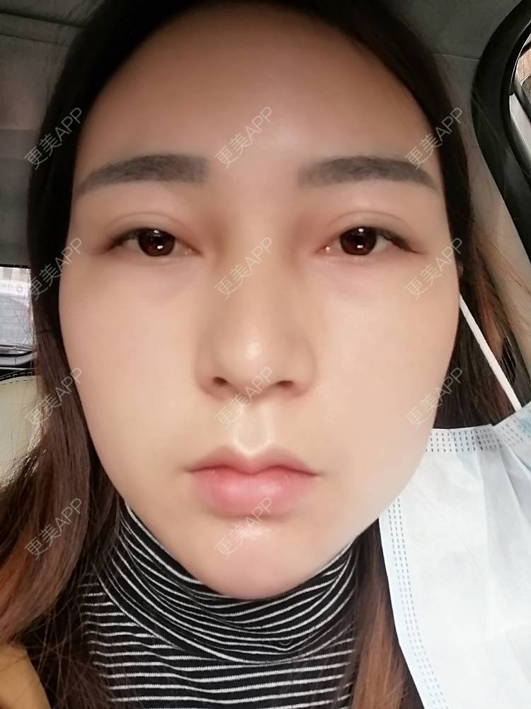 更美 - 更美用户35W00VbmuW的玻尿酸苹果肌经验 | 玻尿酸苹果肌 | 成都