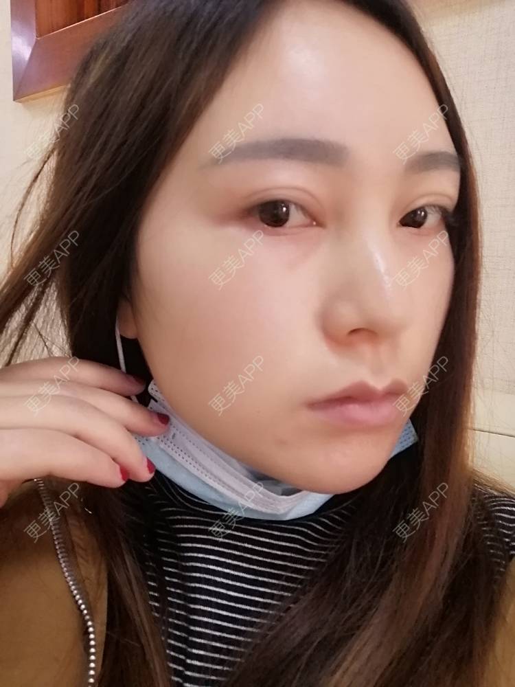 更美 - 更美用户35W00VbmuW的玻尿酸苹果肌经验 | 玻尿酸苹果肌 | 成都