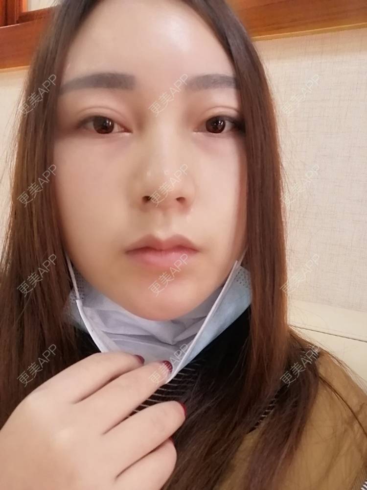更美 - 更美用户35W00VbmuW的玻尿酸苹果肌经验 | 玻尿酸苹果肌 | 成都